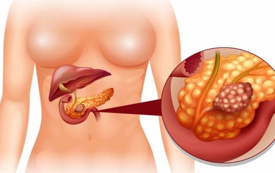 Tumore al pancreas, cosa c'è da sapere - Youbee.it