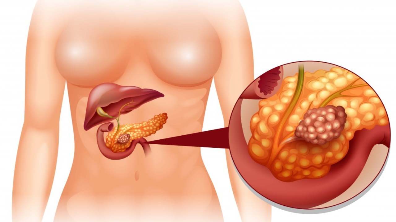 Tumore al pancreas, cosa c'è da sapere - Youbee.it