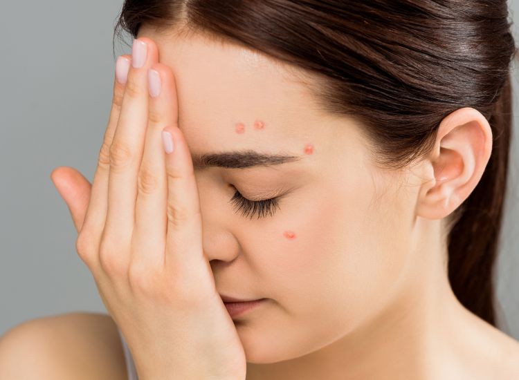 Come trattare le cicatrici dell'acne