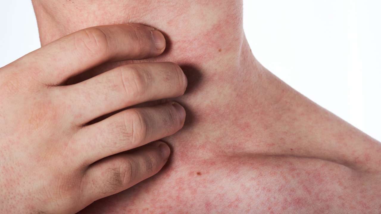 These signs on the skin indicate a very serious zinc deficiency: it is better to take action immediately